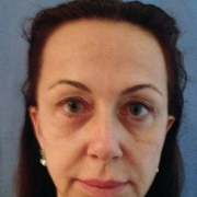 Liftingsopracciclio liftingcervicofacciale_pre.JPG.jpg