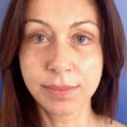 Liftingsopracciclio liftingcervicofacciale_post.JPG.JPG